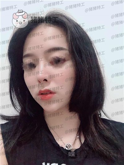厦门福华,金贵香,鼻部手术,案例,价格,