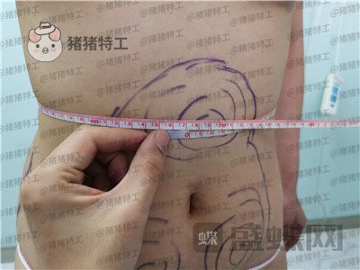 长春盛羽国际,杨本阳,吸脂,案例,价格,