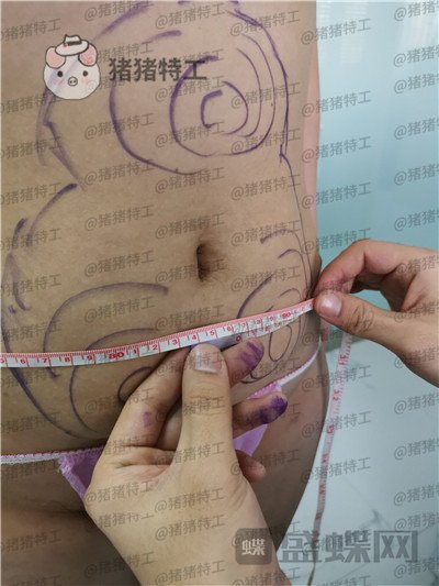 长春盛羽国际,杨本阳,吸脂,案例,价格,