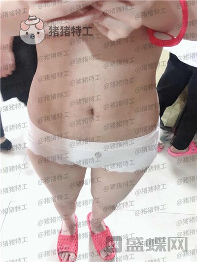 长春盛羽国际,杨本阳,吸脂,案例,价格,