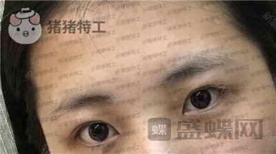 北京长虹,张守玲,双眼皮,案例,价格,