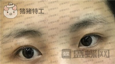 北京长虹,张守玲,双眼皮,案例,价格,