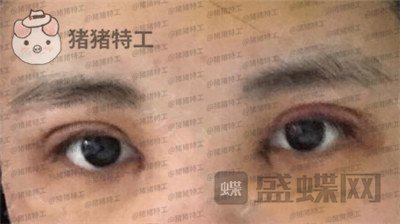 北京长虹,张守玲,双眼皮,案例,价格,
