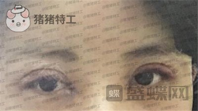 北京长虹,张守玲,双眼皮,案例,价格,