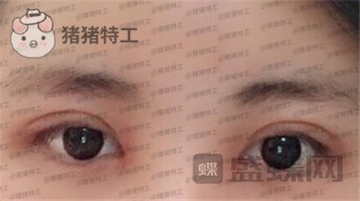 北京长虹,张守玲,双眼皮,案例,价格,