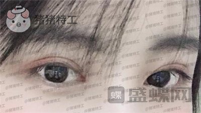 北京长虹,张守玲,双眼皮,案例,价格,