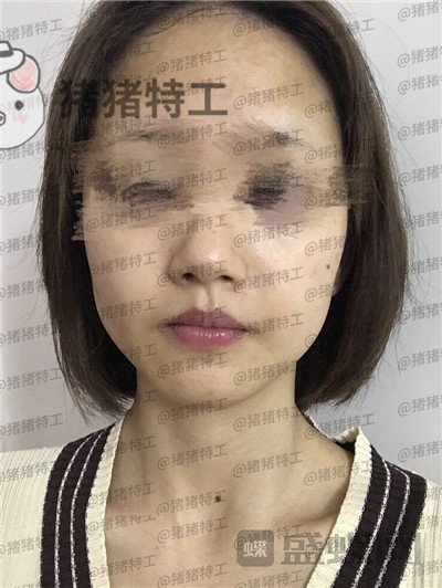 成都美容整形,李静,面部填充,案例,价格,
