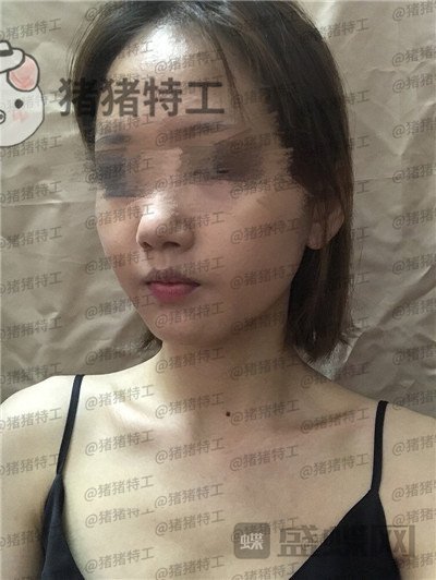 成都美容整形,李静,面部填充,案例,价格,