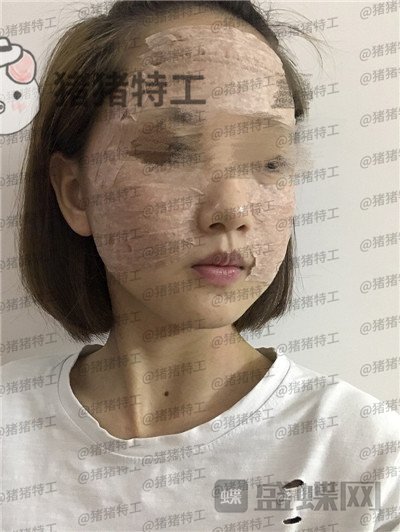 成都美容整形,李静,面部填充,案例,价格,