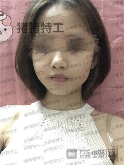 成都美容整形,李静,面部填充,案例,价格,
