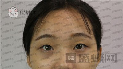长沙亚韩,郑京湘,双眼皮,案例,价格,