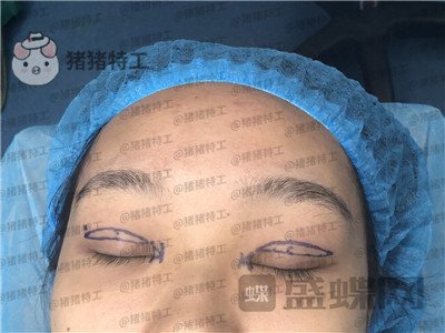 长沙亚韩,郑京湘,双眼皮,案例,价格,