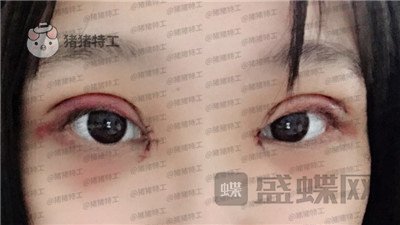 长沙亚韩,郑京湘,双眼皮,案例,价格,
