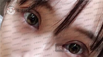 长沙亚韩,郑京湘,双眼皮,案例,价格,