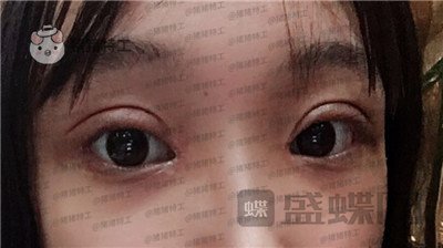长沙亚韩,郑京湘,双眼皮,案例,价格,