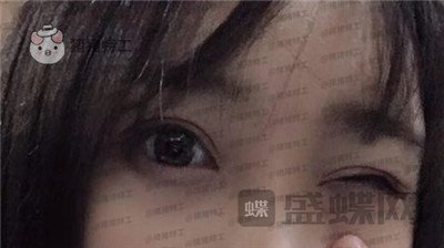 长沙亚韩,郑京湘,双眼皮,案例,价格,