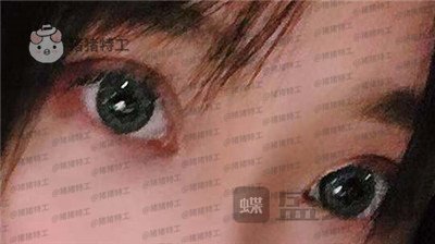 长沙亚韩,郑京湘,双眼皮,案例,价格,