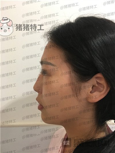 温州伯思立,倪锋,面部填充,案例,价格,