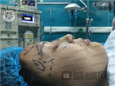 温州伯思立,倪锋,面部填充,案例,价格,