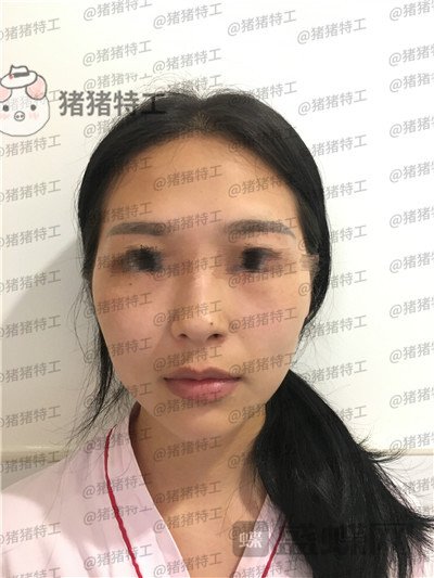 温州伯思立,倪锋,面部填充,案例,价格,