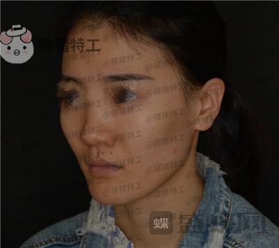 成都天使之翼,尤军,面部填充,案例,价格,
