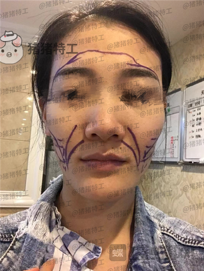 成都天使之翼,尤军,面部填充,案例,价格,