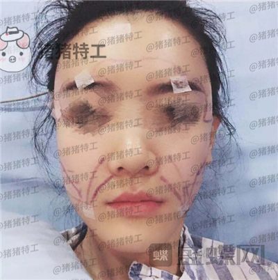 成都天使之翼,尤军,面部填充,案例,价格,
