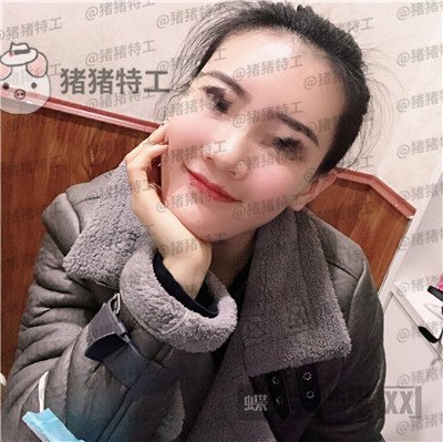 成都天使之翼,尤军,面部填充,案例,价格,