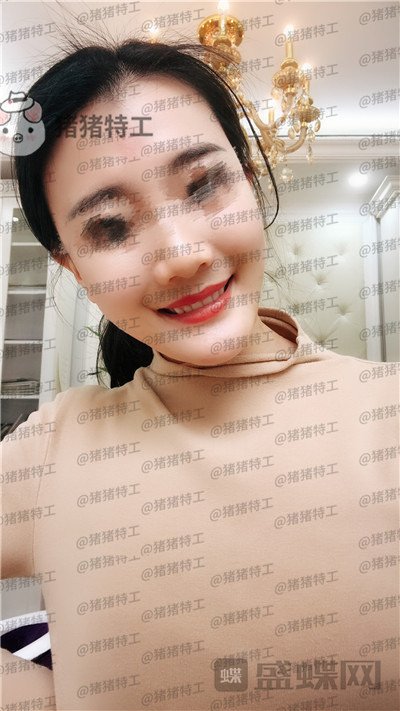 成都天使之翼,尤军,面部填充,案例,价格,