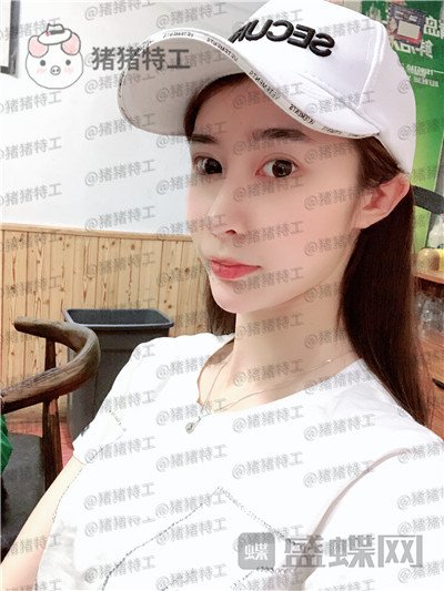 杭州维多利亚,刘中策,鼻部手术,案例,价格,