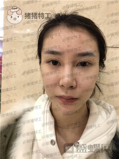 杭州维多利亚,刘中策,鼻部手术,案例,价格,