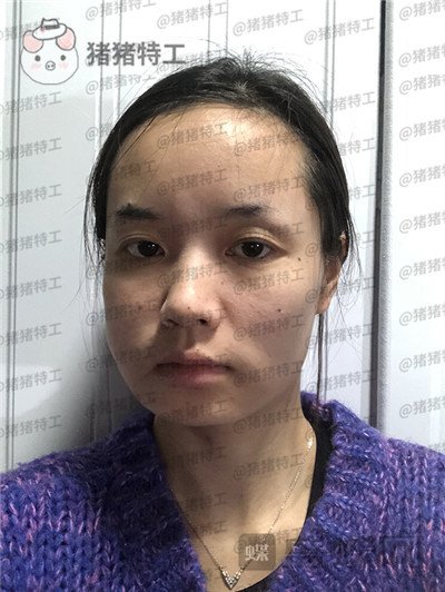 重庆万家燕,王珍祥,下颌角整形,案例,价格,