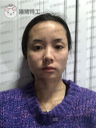 重庆万家燕,王珍祥,下颌角整形,案例,价格,
