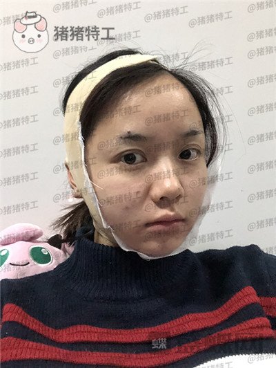 重庆万家燕,王珍祥,下颌角整形,案例,价格,