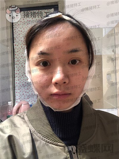 重庆万家燕,王珍祥,下颌角整形,案例,价格,
