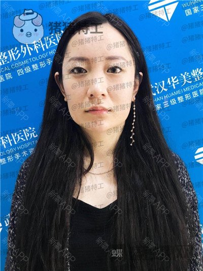 武汉华美,马行,鼻部手术,案例,价格,