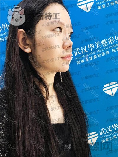 武汉华美,马行,鼻部手术,案例,价格,