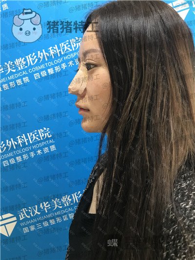 武汉华美,马行,鼻部手术,案例,价格,