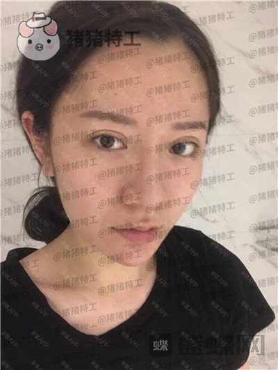 武汉华美,马行,鼻部手术,案例,价格,