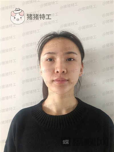 上海愉悦美联臣,荣峥,鼻部手术,案例,价格,