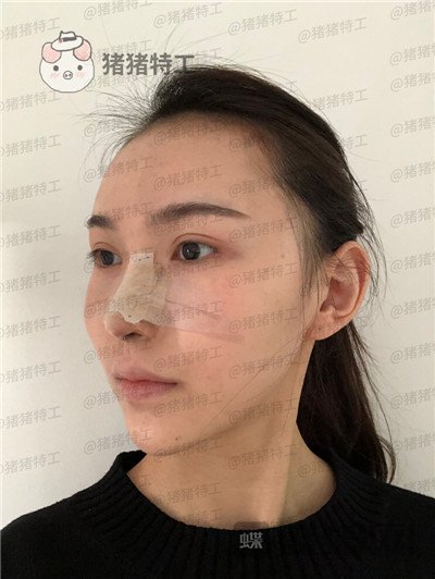上海愉悦美联臣,荣峥,鼻部手术,案例,价格,