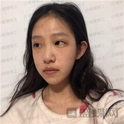 杭州美莱,韩超,鼻部手术,案例,价格,