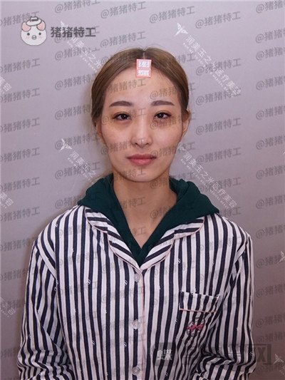 北京润美玉之光,王明利,面部填充,案例,价格,