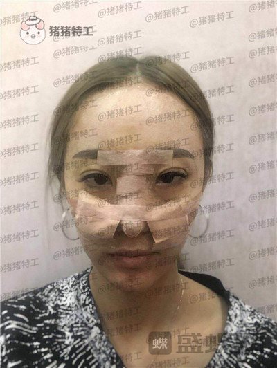 北京润美玉之光,王明利,面部填充,案例,价格,