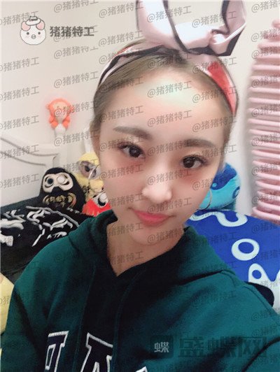 北京润美玉之光,王明利,面部填充,案例,价格,