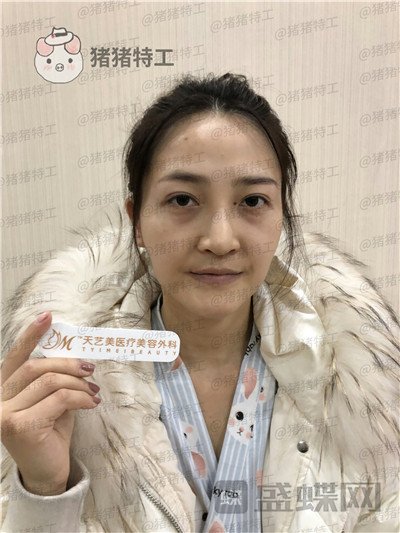 重庆天艺美,徐志强,面部填充,案例,价格,