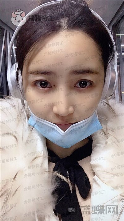 重庆天艺美,徐志强,面部填充,案例,价格,