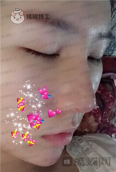 重庆中民整形科,孙刚,鼻部手术,案例,价格,
