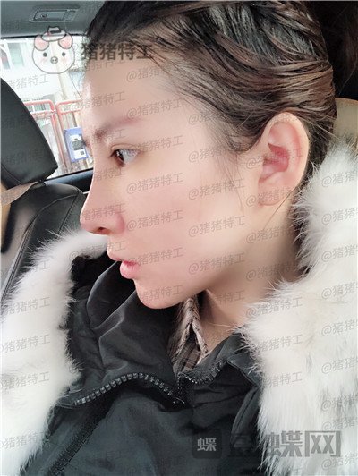 重庆中民整形科,孙刚,鼻部手术,案例,价格,