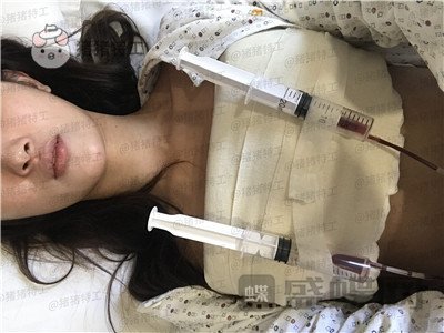 南京美贝尔,黄名斗,隆胸,案例,价格,